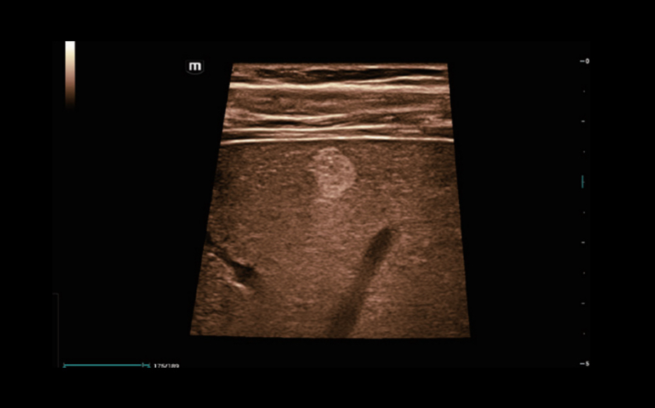 Hemangioma hepático